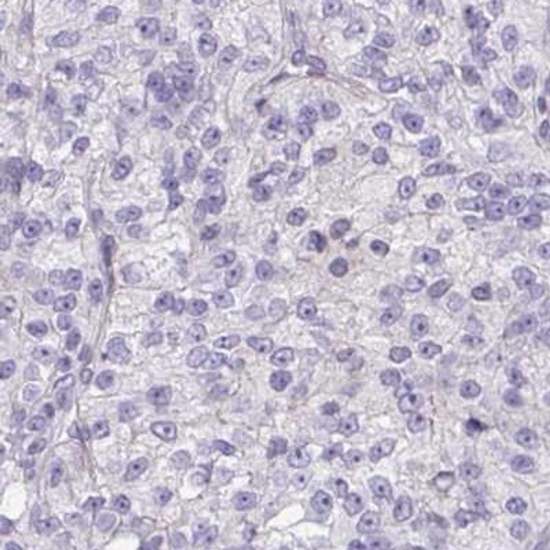 Immunohistochemistry: ATP6V0D2 Antibody [NBP2-31600] - renal cancer