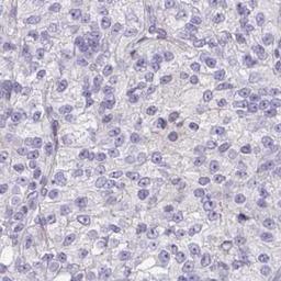 Immunohistochemistry: ATP6V0D2 Antibody [NBP2-31600] - renal cancer