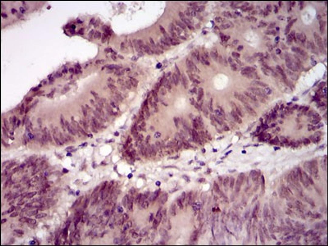 Immunohistochemistry: BPIFB1 Antibody (4H2) [NBP2-37489] - Immunohistochemical analysis of paraffin-embedded colon cancer tissues using Lplunc1 mouse mAb with DAB staining.