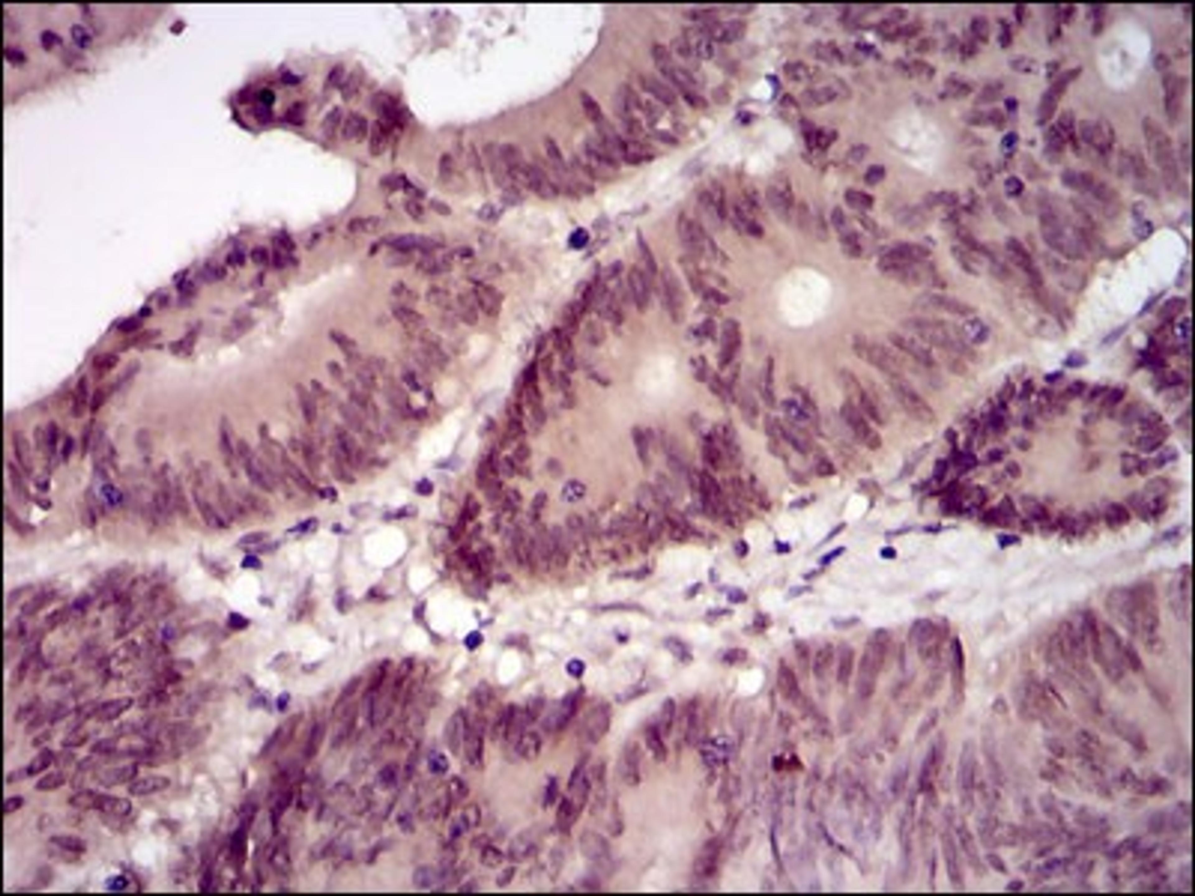 Immunohistochemistry: BPIFB1 Antibody (4H2) [NBP2-37489] - Immunohistochemical analysis of paraffin-embedded colon cancer tissues using Lplunc1 mouse mAb with DAB staining.