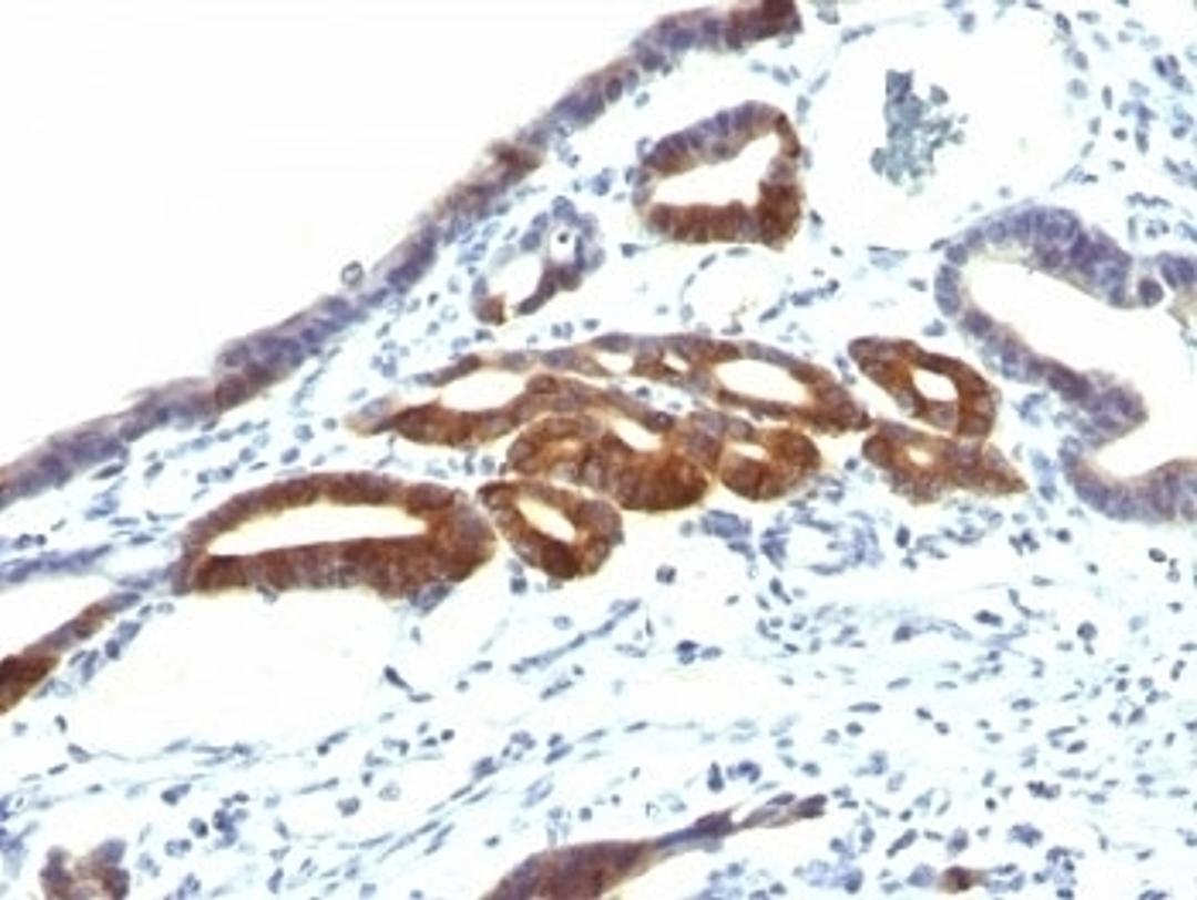 Formalin-fixed, paraffin-embedded human gastric carcinoma stained with anti-MUC6 antibody (SPM598).