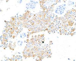 Detection of human CD206/Mannose Receptor in FFPE lung carcinoma pleural effusion by IHC.