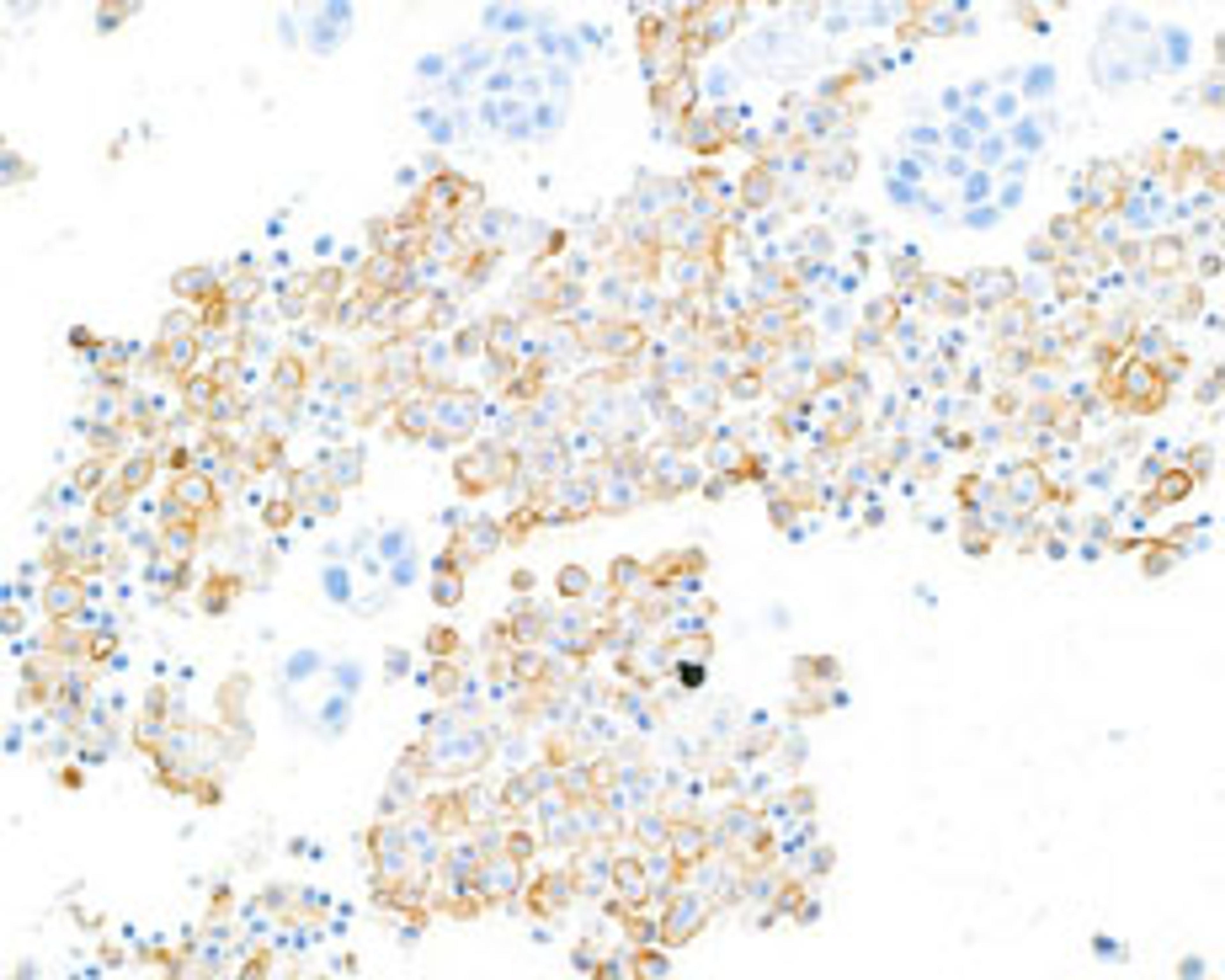 Detection of human CD206/Mannose Receptor in FFPE lung carcinoma pleural effusion by IHC.