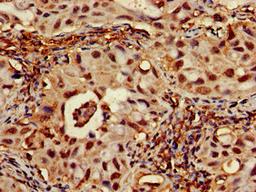 Immunohistochemistry of paraffin-embedded human lung cancer using CSB-PA020088LA01HU at dilution of 1:100