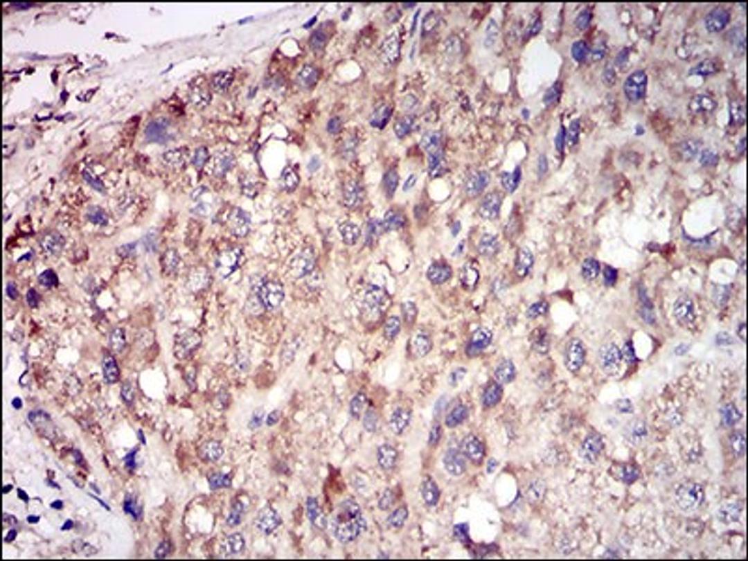 Immunohistochemistry: TRACP/PAP/ACP5 Antibody (7E6A11) [NBP2-37337] - Immunohistochemical analysis of paraffin-embedded liver cancer tissues using ACP5 mouse mAb with DAB staining.