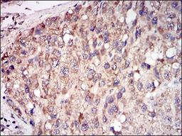 Immunohistochemistry: TRACP/PAP/ACP5 Antibody (7E6A11) [NBP2-37337] - Immunohistochemical analysis of paraffin-embedded liver cancer tissues using ACP5 mouse mAb with DAB staining.