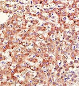 Immunohistochemical analysis of formalin fixed and paraffin embedded human cervical carcinoma using RAR beta antibody