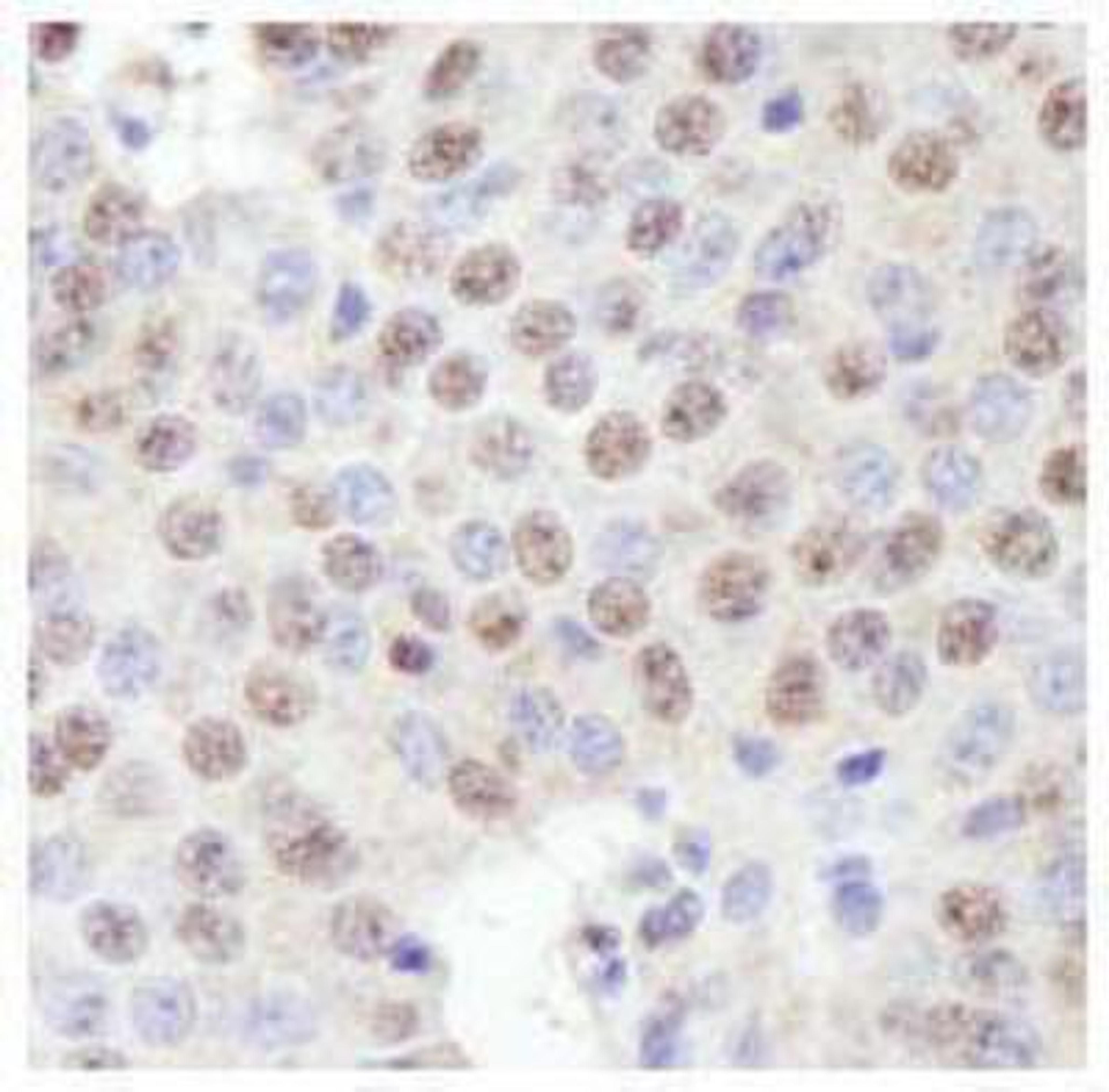 Immunohistochemistry-Paraffin: ZFP106 Antibody [NB100-74654] - Detection of Human ZFP106. Sample: FFPE section of human pancreatic islet cell tumor. Antibody: Affinity purified rabbit anti-ZFP106  used at a dilution of 1:250.