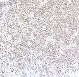 Detection of human FOXP1 in FFPE Burkitt lymphoma by immunohistochemistry.