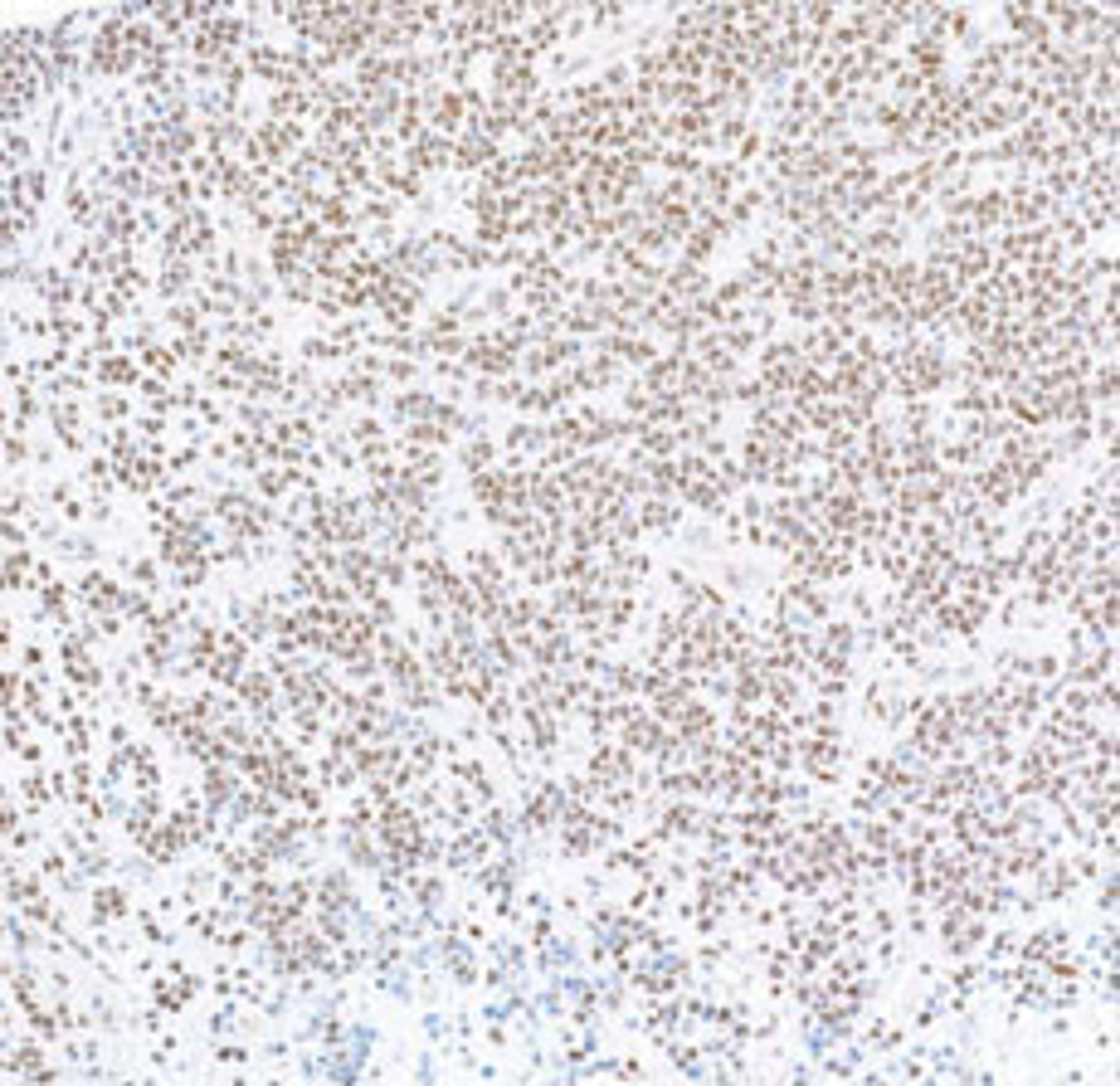 Detection of human FOXP1 in FFPE Burkitt lymphoma by immunohistochemistry.