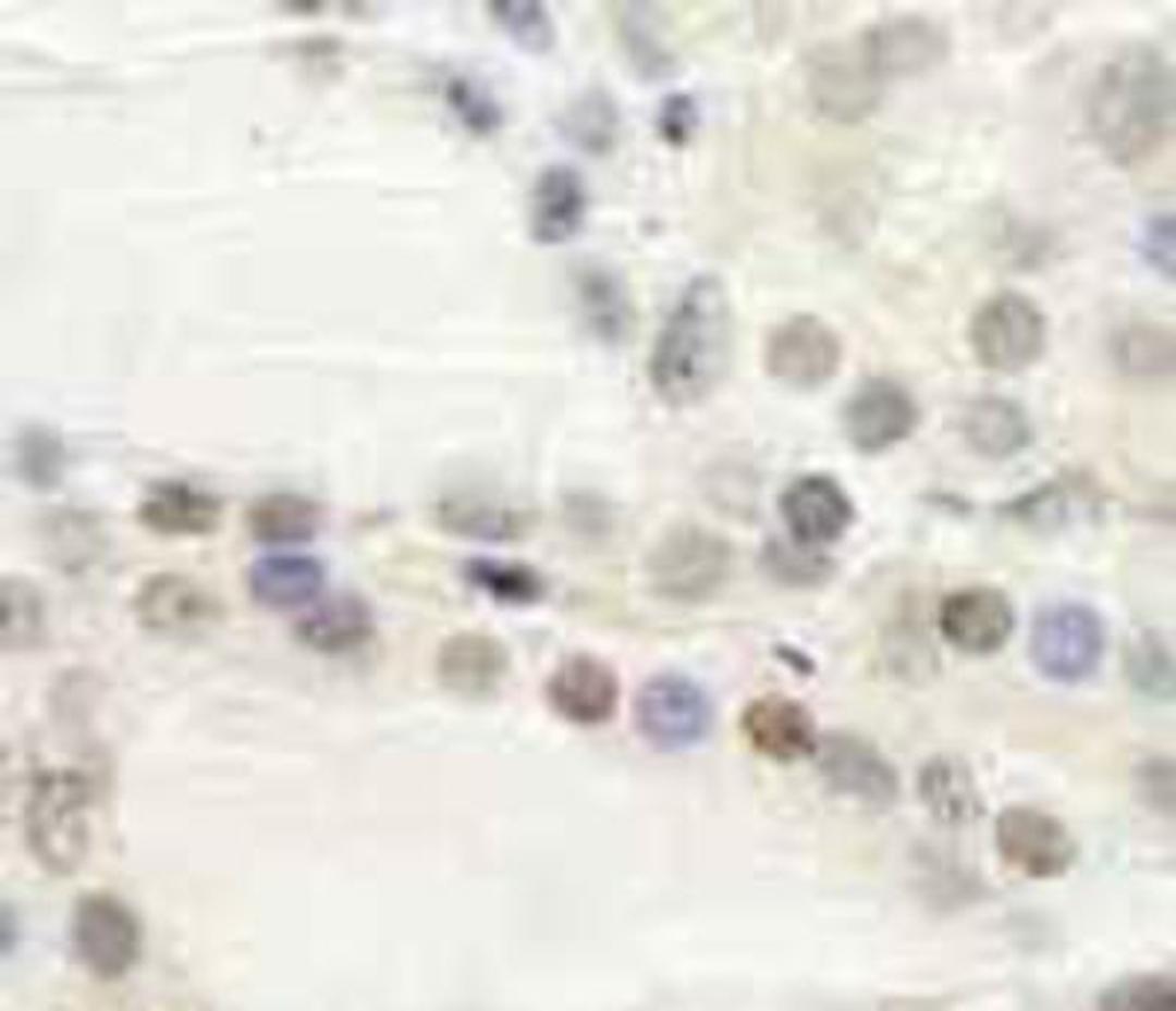 Immunohistochemistry-Paraffin: GTF3C2 Antibody [NB100-60429] - FFPE section of human thyroid carcinoma.  Affinity purified rabbit anti-GTF3C2/TFIIIC110 used at a dilution of 1:250.