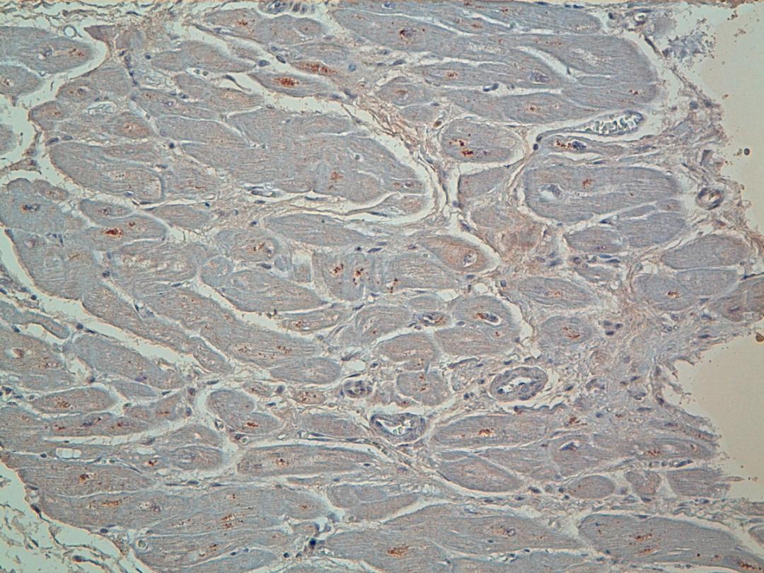 Immunohistochemical staining of paraffin embedded heart affected by idiopathic cardiomyopathy using Parkin antibody (dilution 1:50)