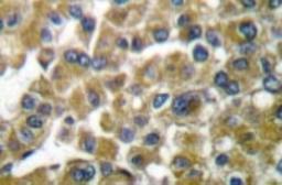 Immunohistochemistry: MMP3 Antibody [NB100-91878] - Analyzes of MMP-3 (S453) antibody in paraffin-embedded human breast  carcinoma tissue.