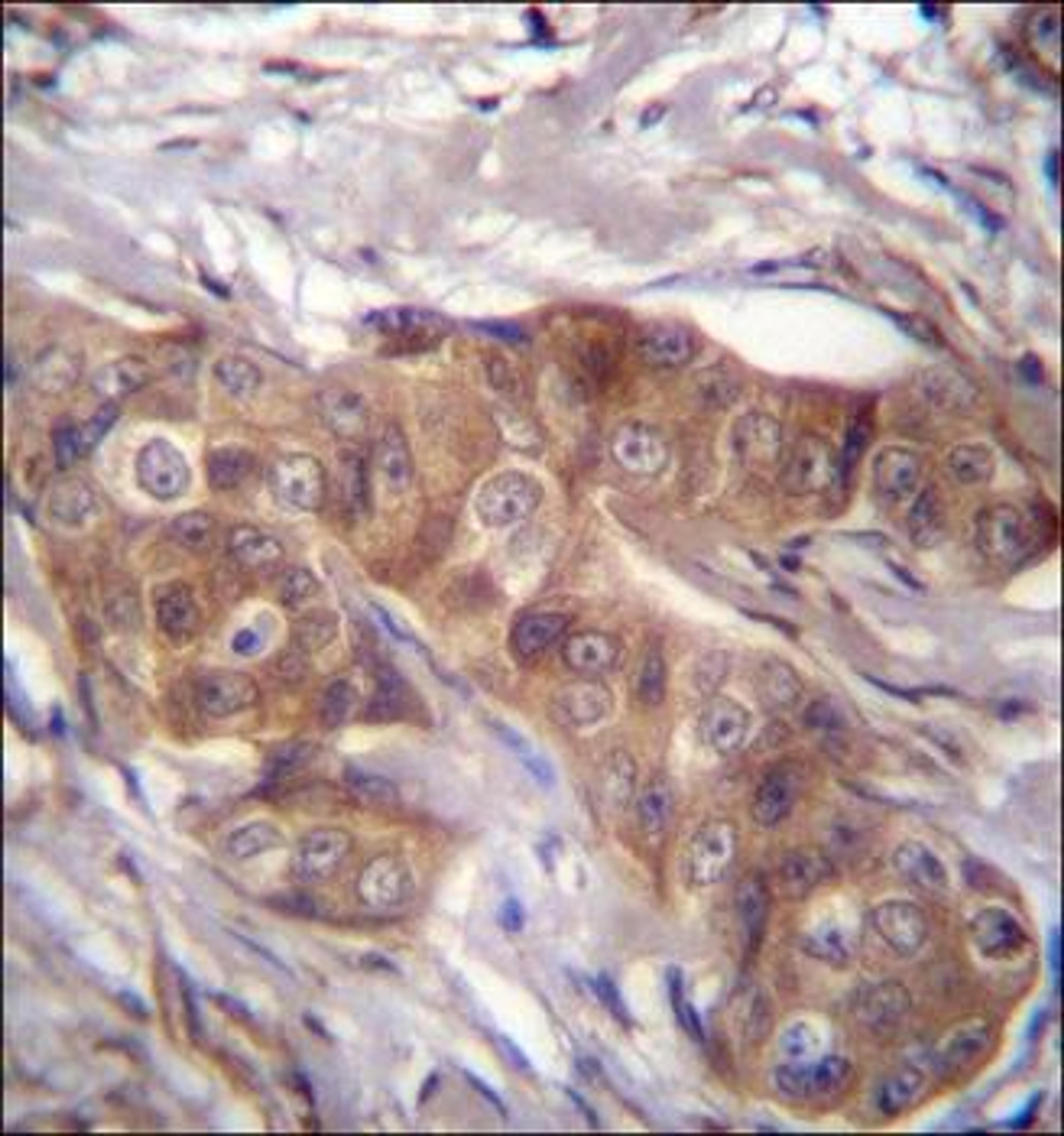 Immunohistochemical staining of paraffin embedded human breast carcinoma tissue using LPAR6 antibody (primary antibody dilution at: 1:10-50)