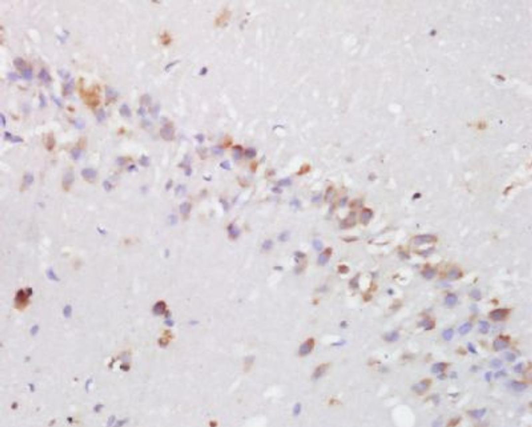 Immunohistochemical analysis of human lung carcinoma tissue using hydroxyproline antibody