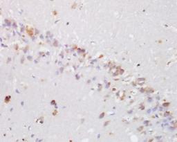 Immunohistochemical analysis of human lung carcinoma tissue using hydroxyproline antibody