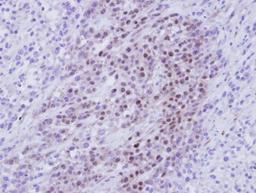 Immunohistochemistry-Paraffin: RBMY1A1 Antibody [NBP1-32887] - Paraffin-embedded SAS Xenograft, using antibody at 1:100 dilution.