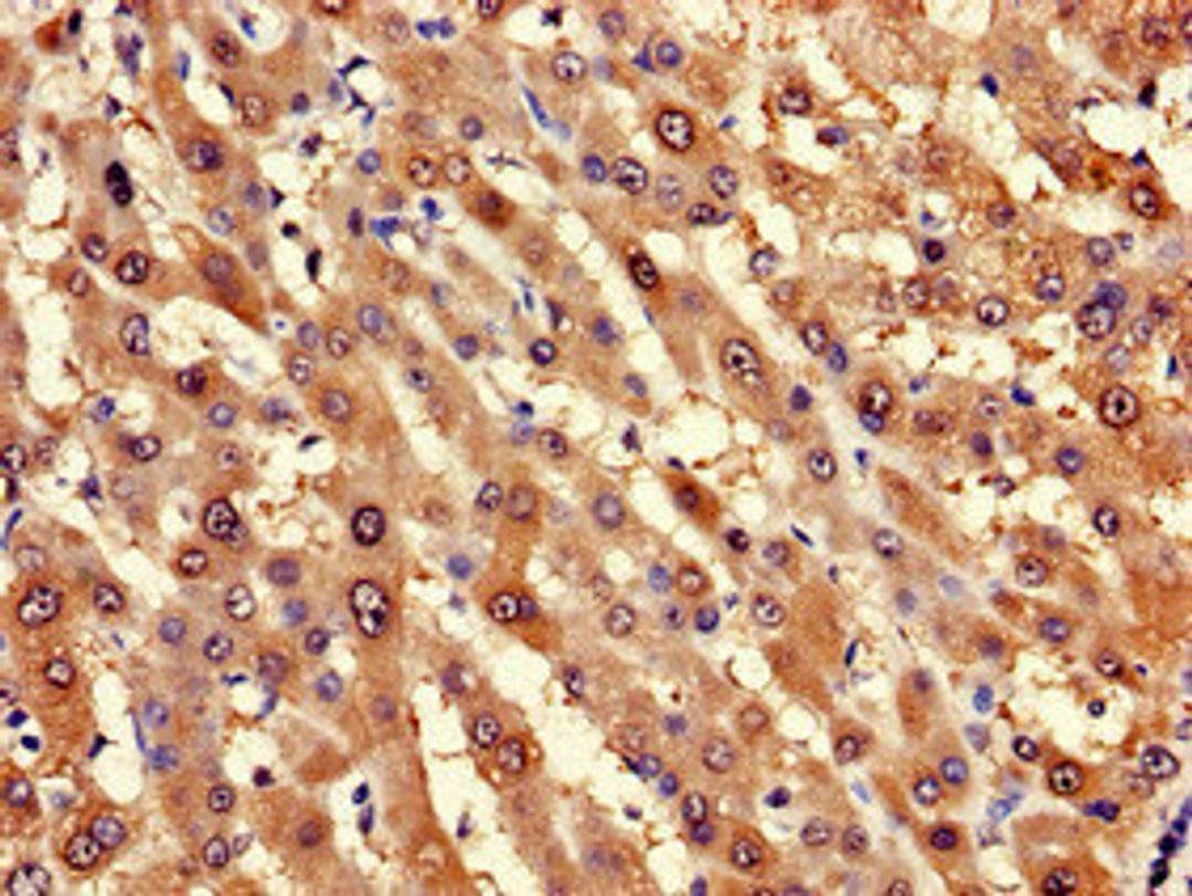 Immunohistochemistry of paraffin-embedded human liver cancer using CSB-PA821685LA01HU at dilution of 1:100