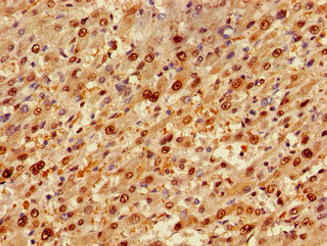 Immunohistochemistry of paraffin-embedded human liver cancer using CSB-PA822174LA01HU at dilution of 1:100