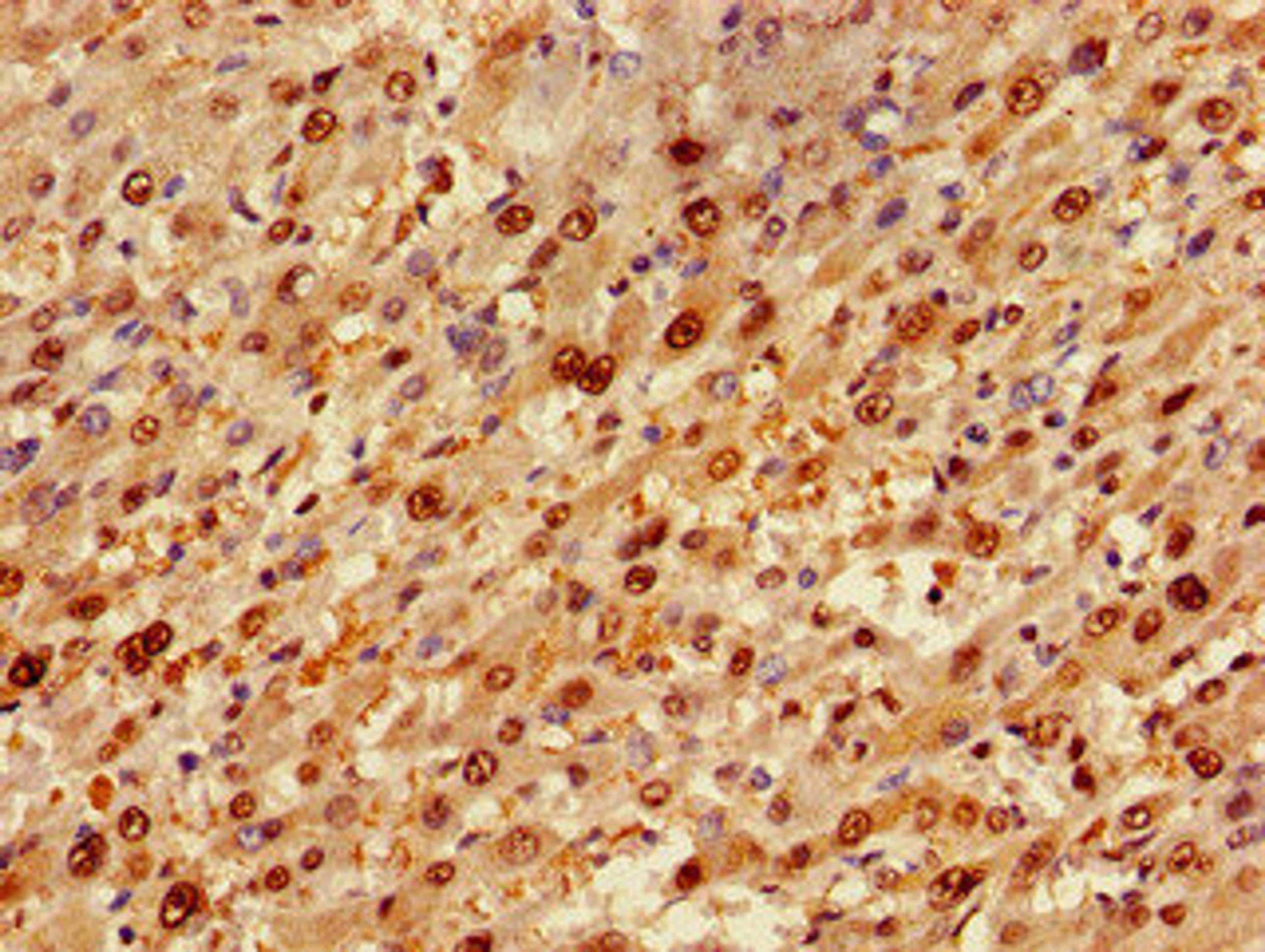 Immunohistochemistry of paraffin-embedded human liver cancer using CSB-PA822174LA01HU at dilution of 1:100