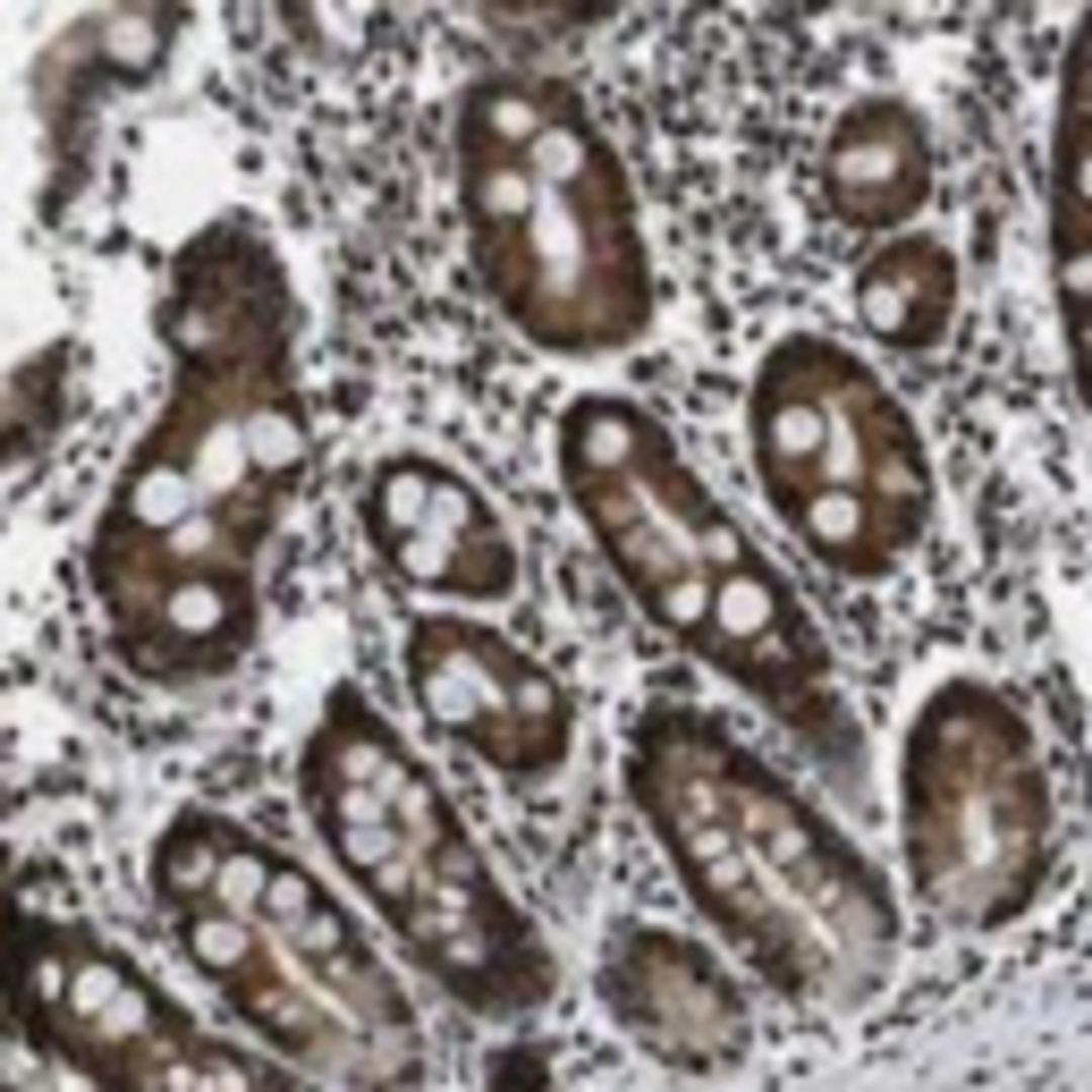 Immunohistochemistry: RECQL4 Antibody [25470002] - Most of the normal tissues displayed strong nuclear positivity combined with slightly weaker cytoplasmic staining. Hepatocytes were weakly stained. Malignant tissues exhibited moderate nuclear immunoreactivity which occasionally was accompanied with cytoplasmic staining. Most malignant gliomas and cases of for example malignant carcinoids, lymphomas, colo-rectal and renal cancers showed strong staining.  Image and statement courtesy of the Human Protein Atlas (HPA).