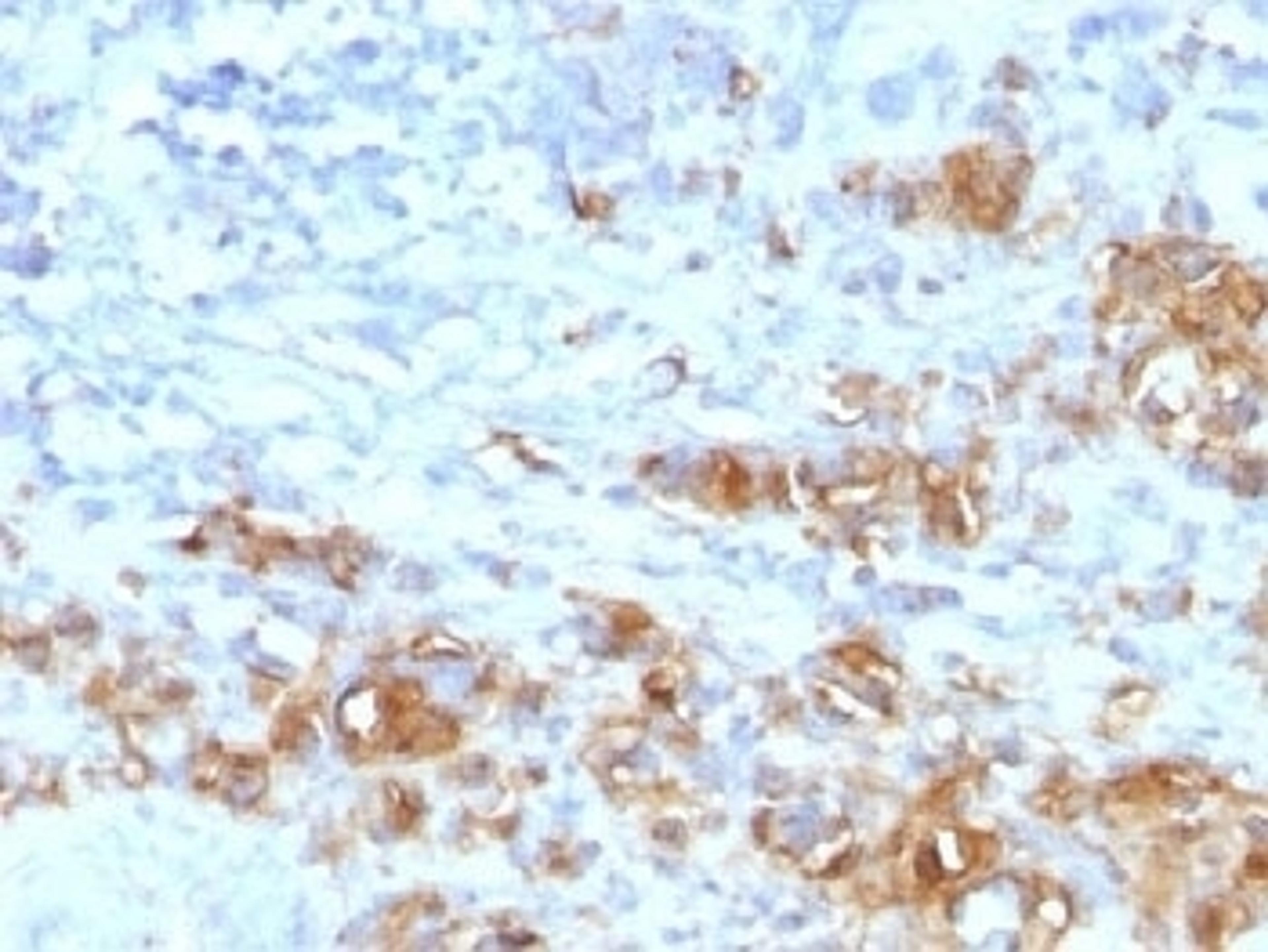 IHC testing of FFPE human gastric carcinoma with recombinant CA19-9 antibody (CA19.9/1390R). HIER: steam sections in pH6 citrate buffer for 10-20 min.