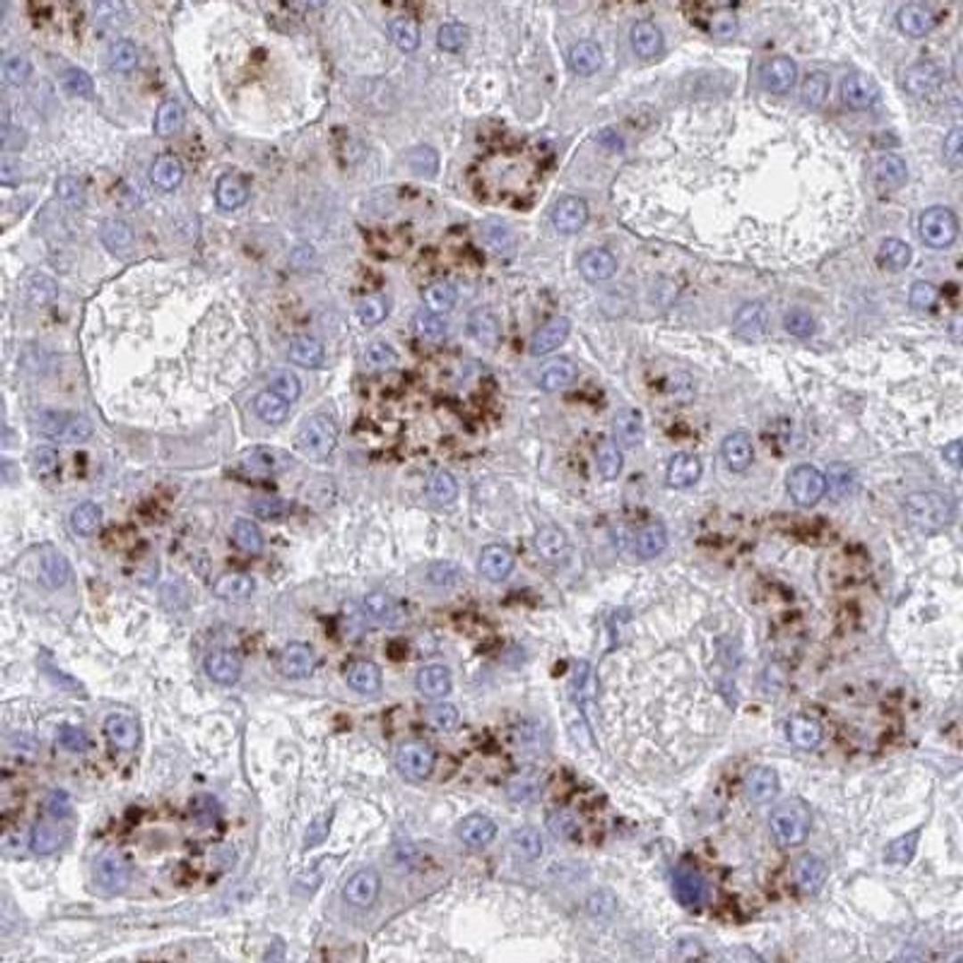 Immunohistochemistry: OR10X1 Antibody [NBP2-32579] - liver cancer