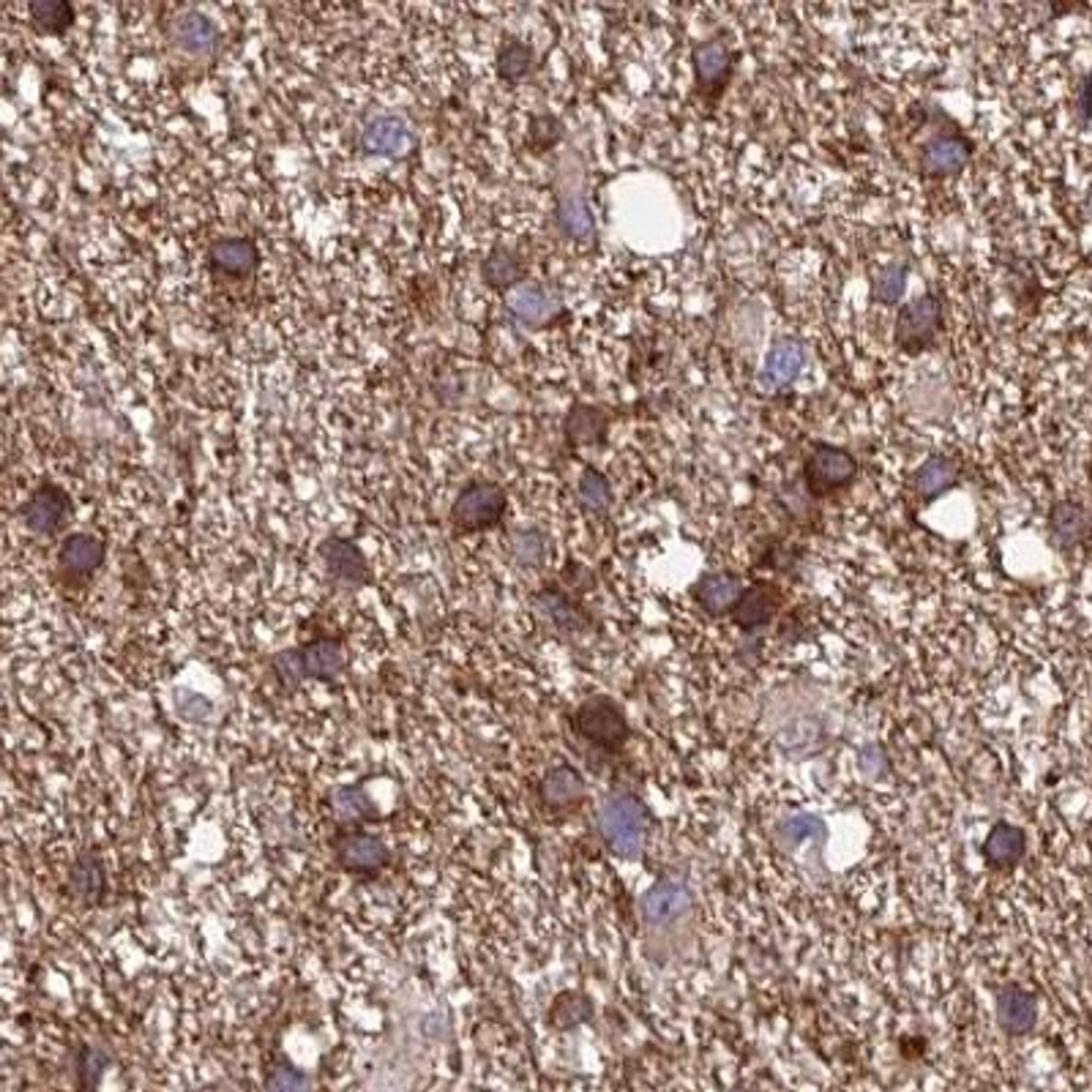 Immunohistochemistry: DENND5B Antibody [NBP2-31971] - glioma