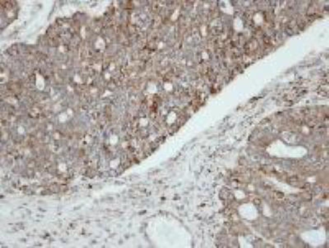 Immunohistochemistry: Growth Hormone R Antibody [NBP1-31420] - Analysis of paraffin-embedded serous OVCA , using NBP1-31420 at 1:100 dilution.