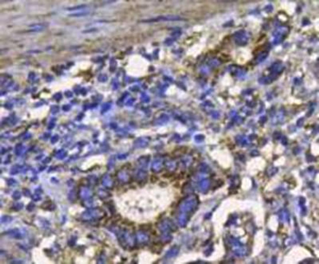 Immunohistochemical staining of human stomach carcinoma tissue using CD332 antibody