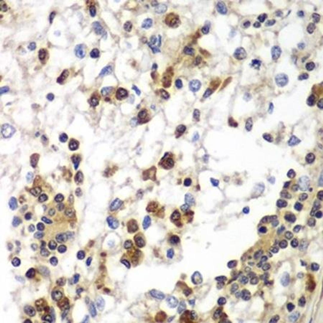 Immunohistochemical staining of human kidney cancer tissue using SND1 antibody