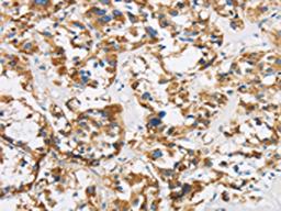 The image is immunohistochemistry of paraffin-embedded Human thyroid cancer tissue using CSB-PA877027(COX6B1 Antibody) at dilution 1/50. (Original magnification: ×200)