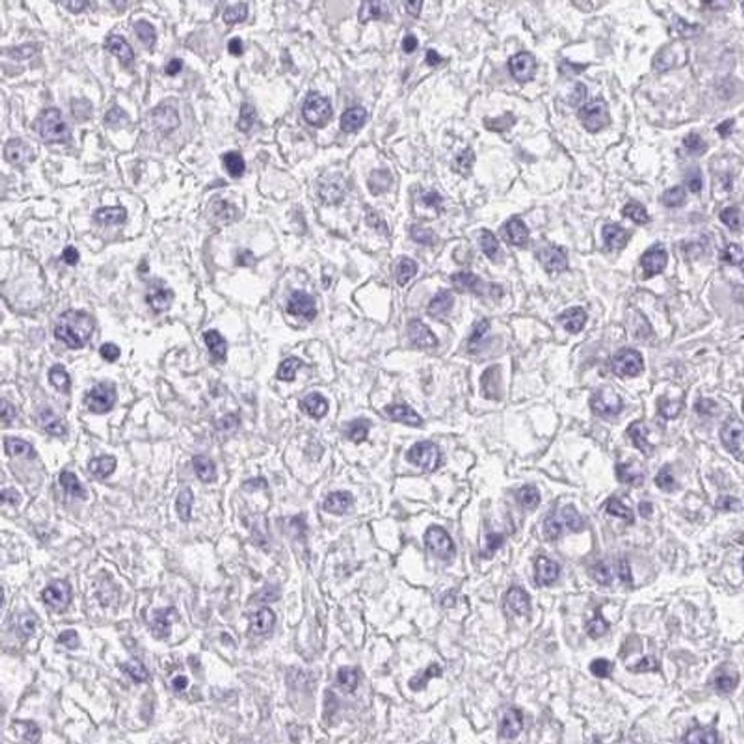 Immunohistochemistry: IL1F10 Antibody [NBP2-31798] - liver cancer