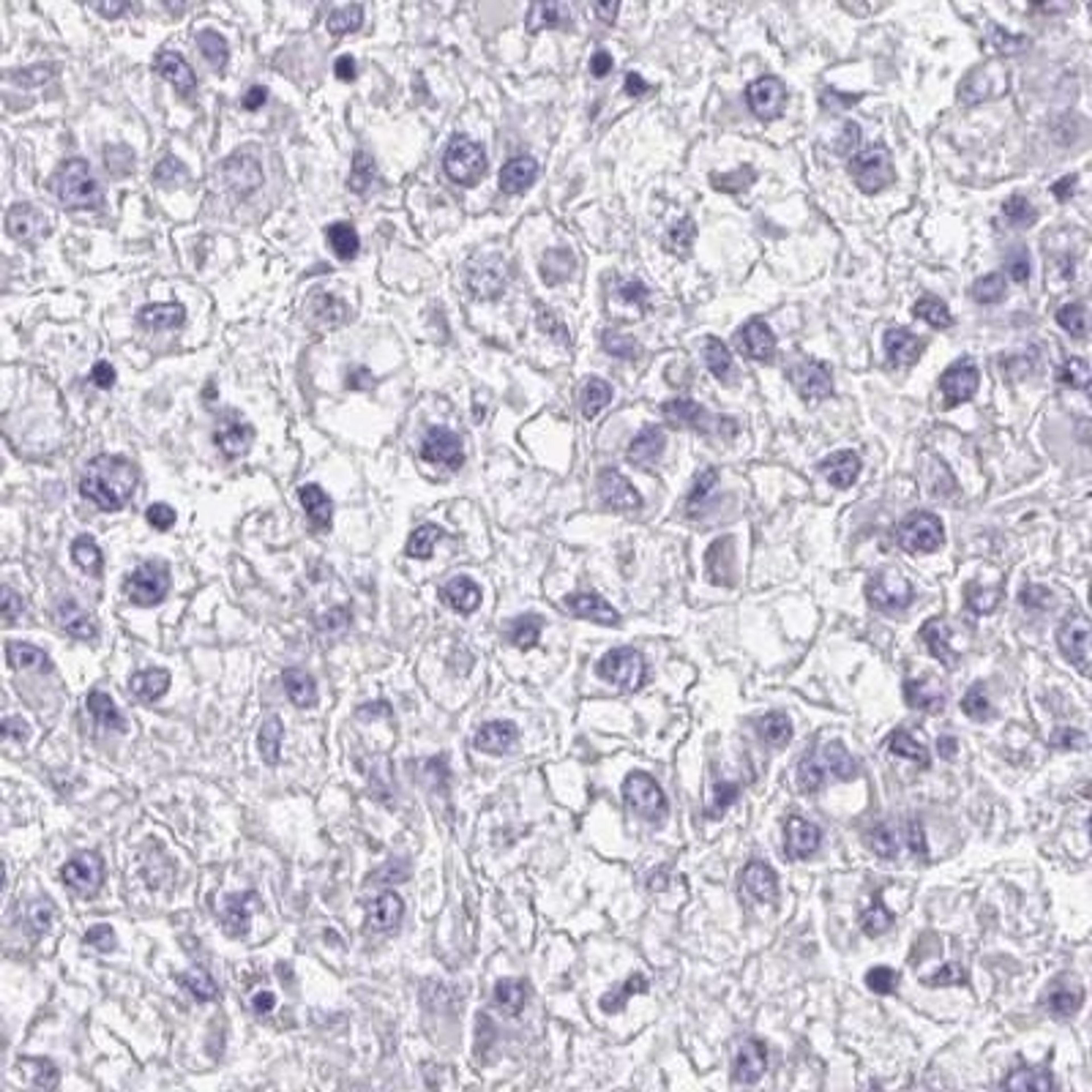 Immunohistochemistry: IL1F10 Antibody [NBP2-31798] - liver cancer