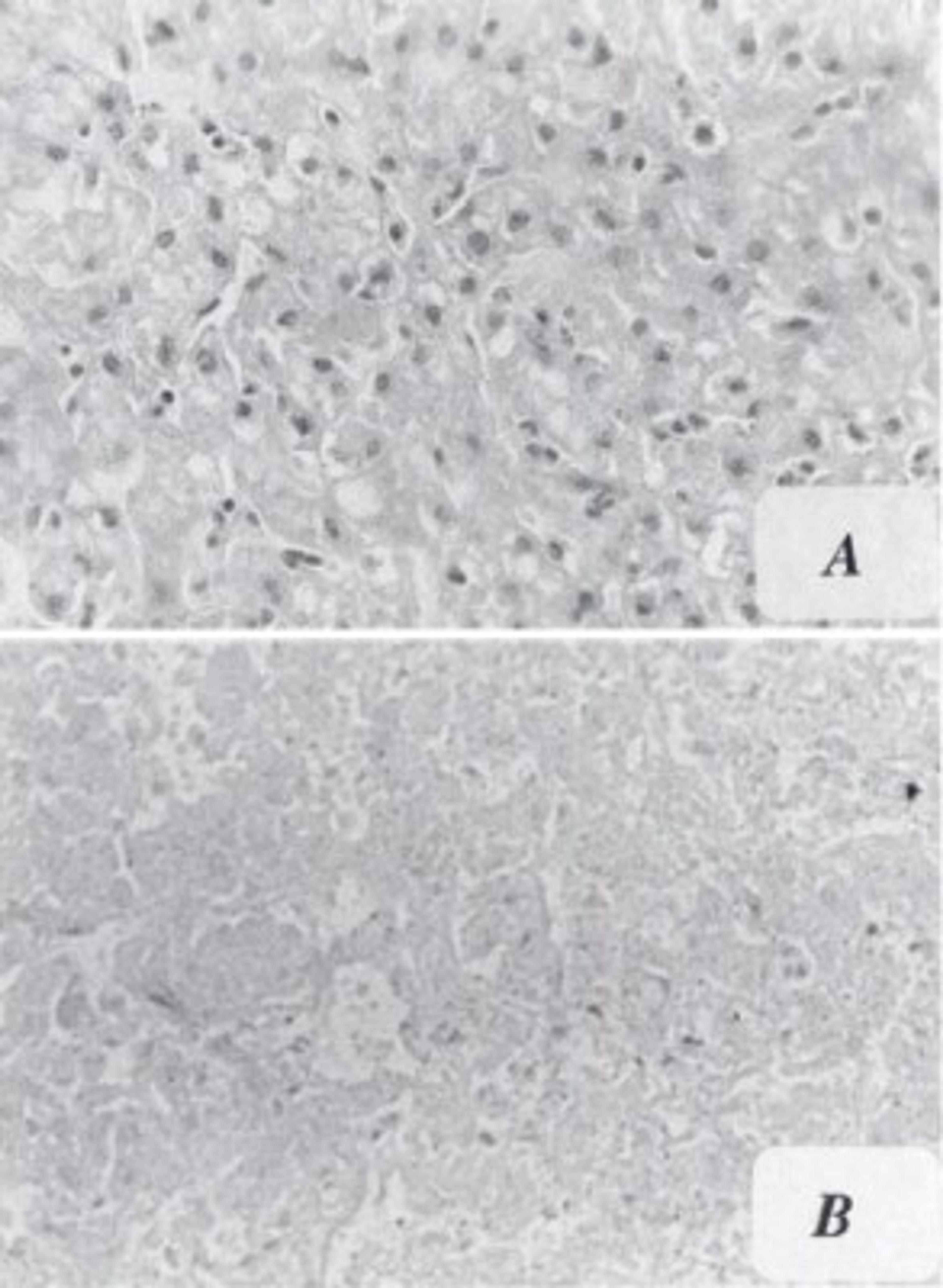 Immunohistochemistry: Aflatoxin B1 Antibody (6A10) [NB600-443] - Immuno staining of positive (A) and negative (B) tumor tissues for AFB, -DNA adducts. Photos courtesy of Dr. Regina Santella.