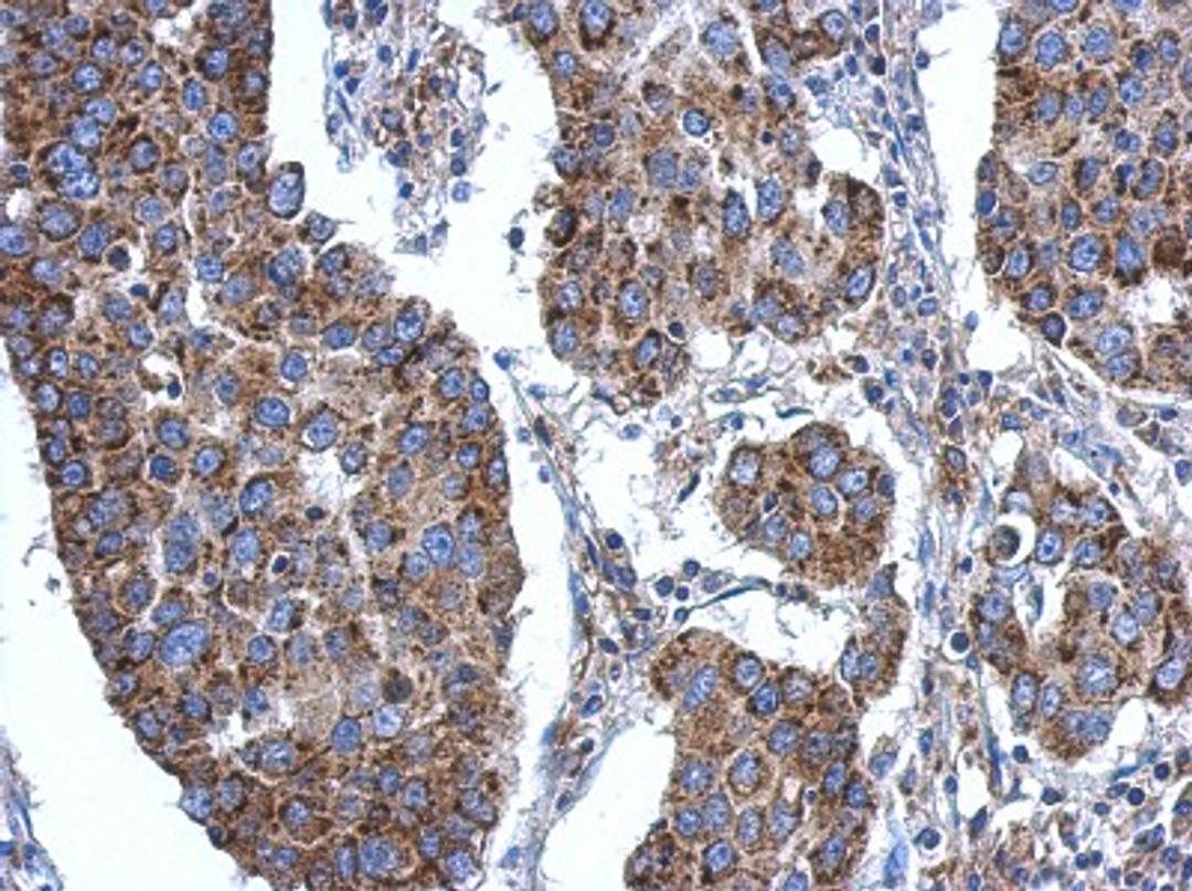 Immunohistochemistry-Paraffin: ACSL3 Antibody [NBP2-15252] - Paraffin-embedded Breast ca, using antibody at 1:500 dilution.