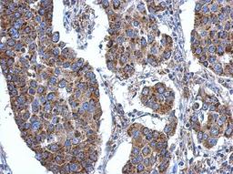 Immunohistochemistry-Paraffin: ACSL3 Antibody [NBP2-15252] - Paraffin-embedded Breast ca, using antibody at 1:500 dilution.