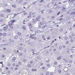 Immunohistochemistry: OR4C16 Antibody [NBP2-32428] - liver cancer