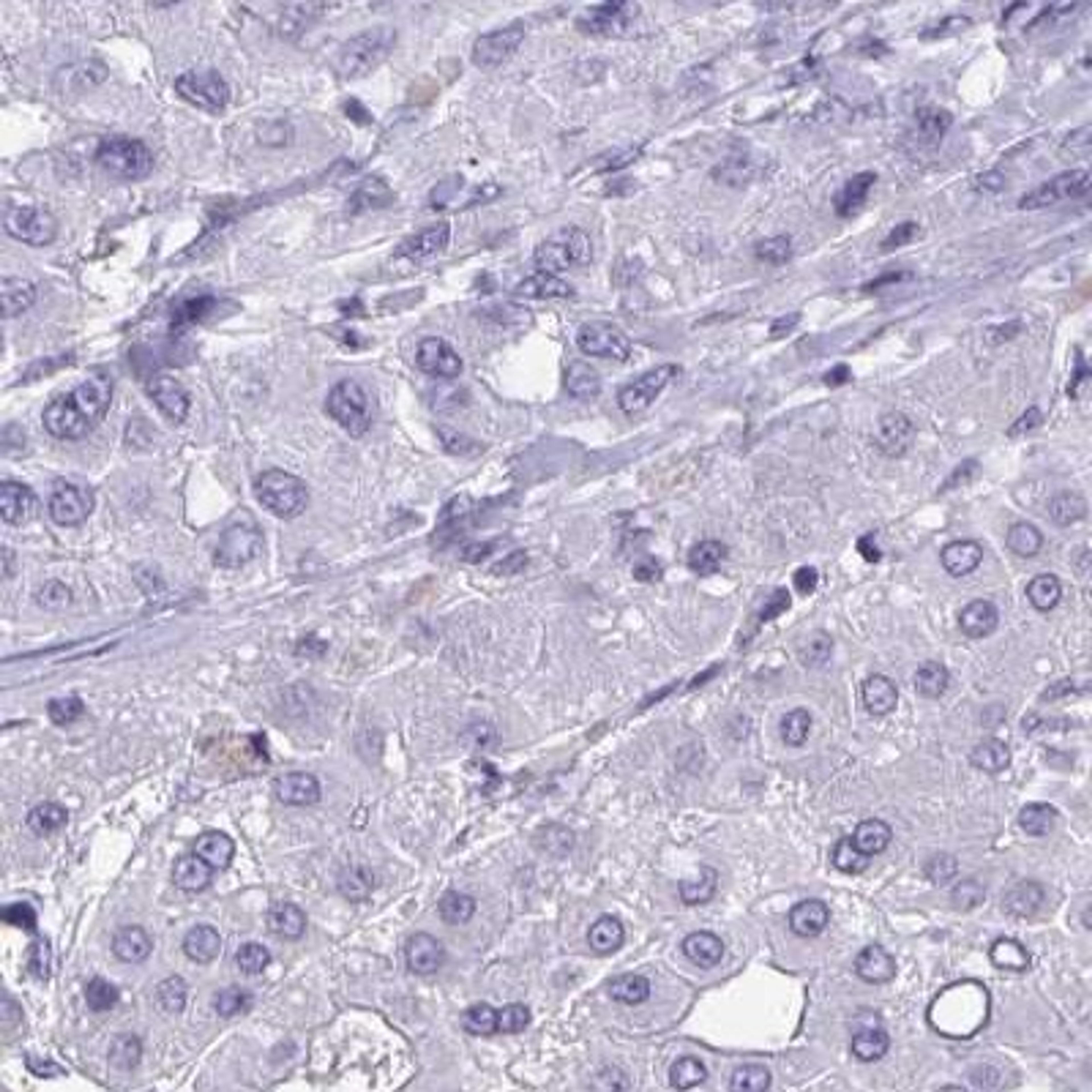 Immunohistochemistry: OR4C16 Antibody [NBP2-32428] - liver cancer