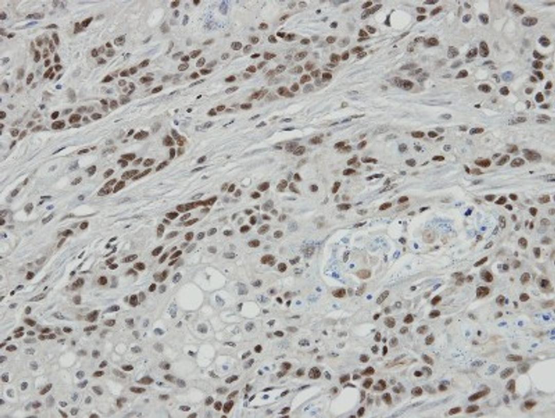 Immunohistochemistry-Paraffin: Bcl 7A Antibody [NBP1-30941] - Paraffin-embedded oral CA cell lines Ca922 xenograft, using antibody at 1:100 dilution.