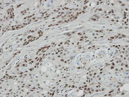 Immunohistochemistry-Paraffin: Bcl 7A Antibody [NBP1-30941] - Paraffin-embedded oral CA cell lines Ca922 xenograft, using antibody at 1:100 dilution.