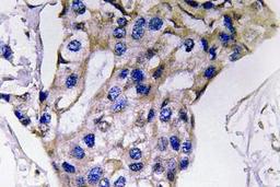 Immunohistochemistry-Paraffin: IL-5 Antibody [NBP1-19749] -  Human breast carcinoma tissue.