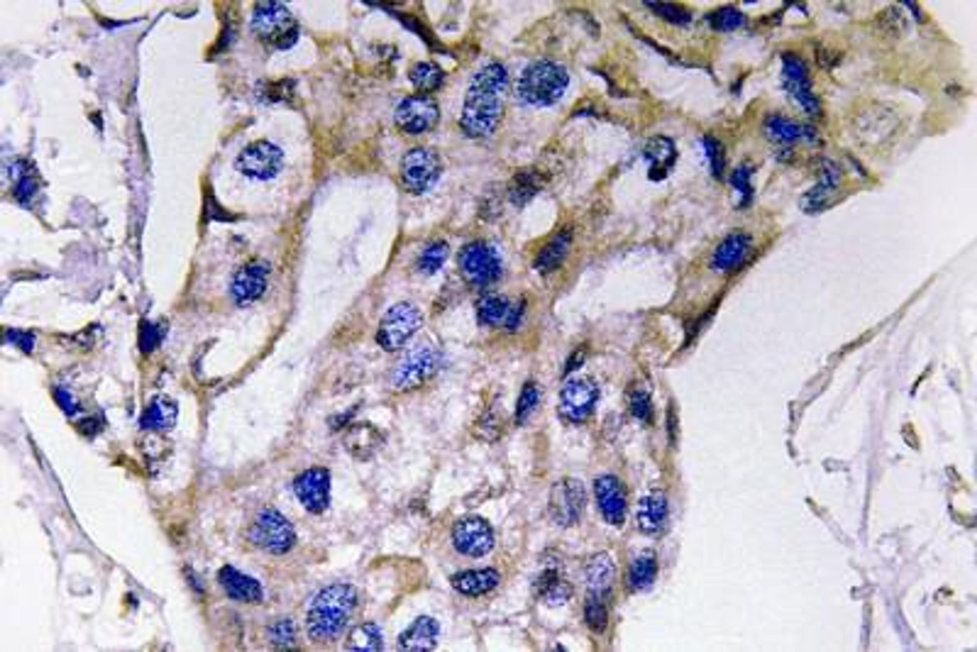 Immunohistochemistry-Paraffin: IL-5 Antibody [NBP1-19749] -  Human breast carcinoma tissue.