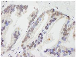 Immunohistochemistry-Paraffin: RNF41 Antibody [NB100-583] - FFPE section of human prostate adenocarcinoma.  Affinity purified rabbit anti- FLRF/RNF41 used at a dilution of 1:250.