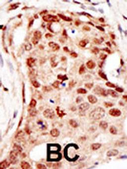 Formalin-fixed and paraffin-embedded human cancer tissue reacted with the primary antibody, which was peroxidase-conjugated to the secondary antibody, followed by DAB staining. BC = breast carcinoma; HC = hepatocarcinoma.