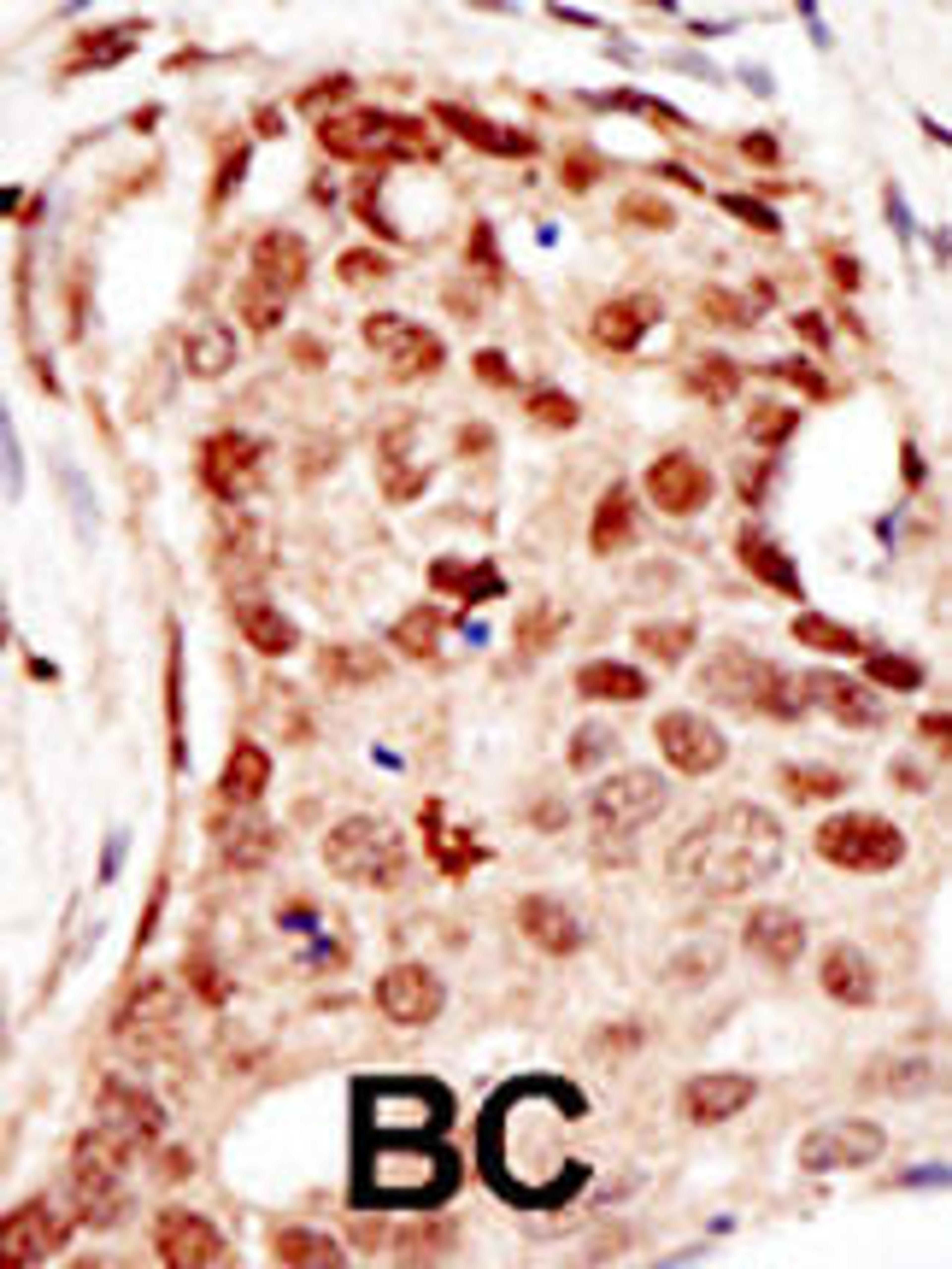 Formalin-fixed and paraffin-embedded human cancer tissue reacted with the primary antibody, which was peroxidase-conjugated to the secondary antibody, followed by DAB staining. BC = breast carcinoma; HC = hepatocarcinoma.