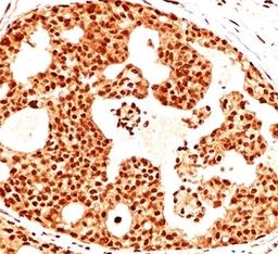 IHC testing of breast cancer stained with Estrogen Receptor beta antibody (ERb455).