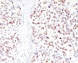 IHC testing of FFPE human melanoma with MITF antibody (clone MPAF3).