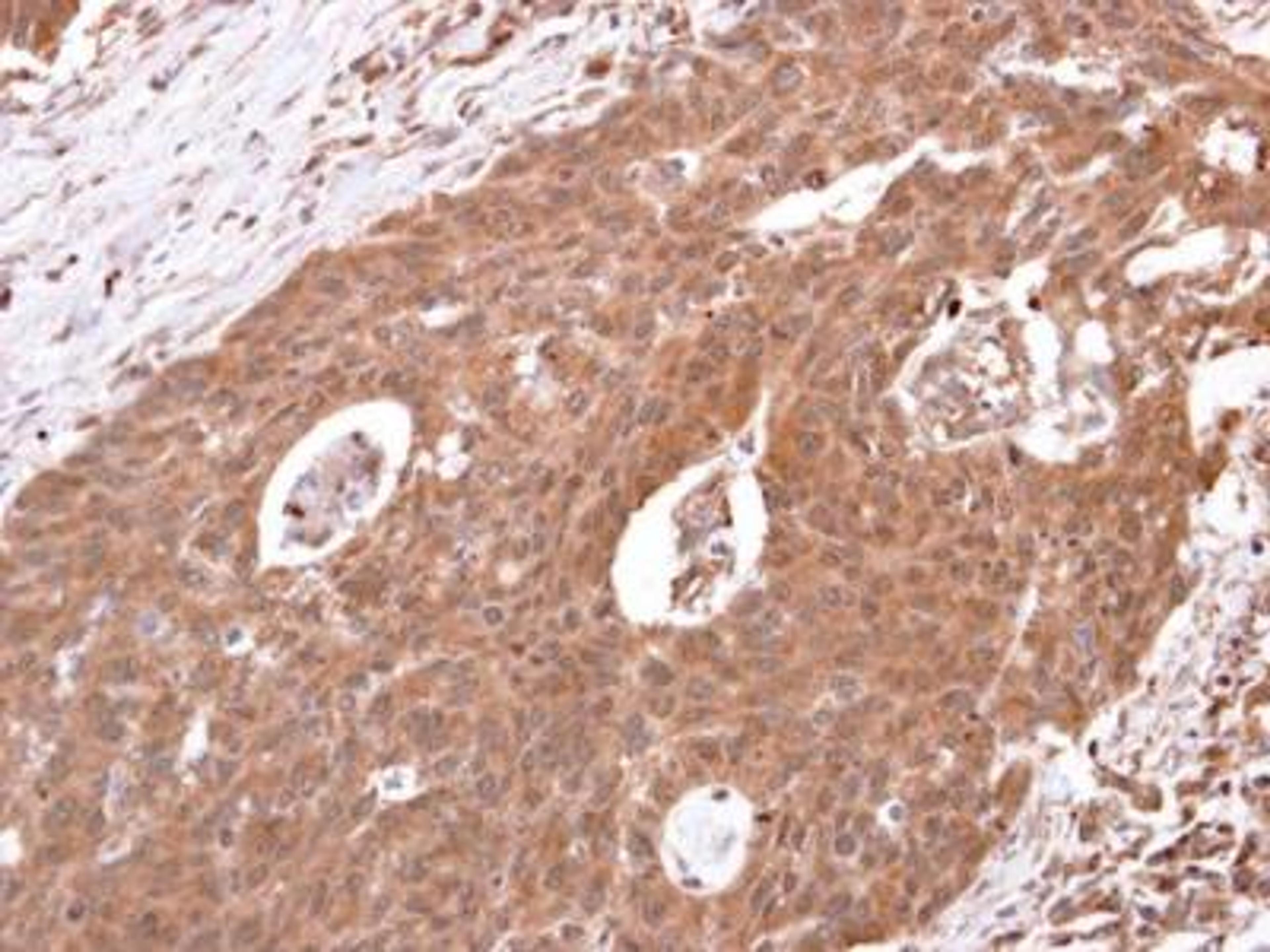 Immunohistochemistry-Paraffin: beta-2 Adrenergic R/ADRB2 Antibody [NBP2-15564] - Human colon carcinoma.