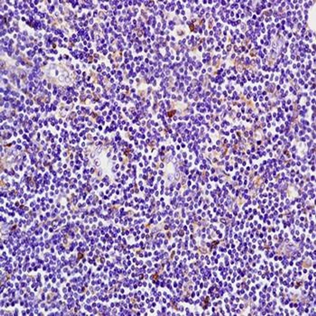 Immunohistochemical analysis of formalin-fixed and paraffin embedded human pancreas carcinoma tissue (Dilution at:1:200) using RIP3 antibody